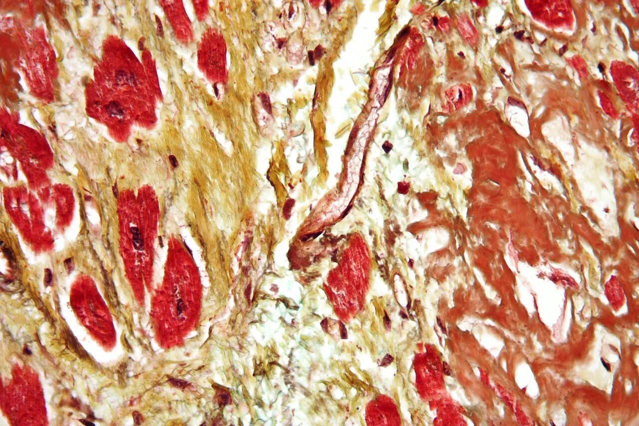 Cardiac amyloidosis very high mag movat