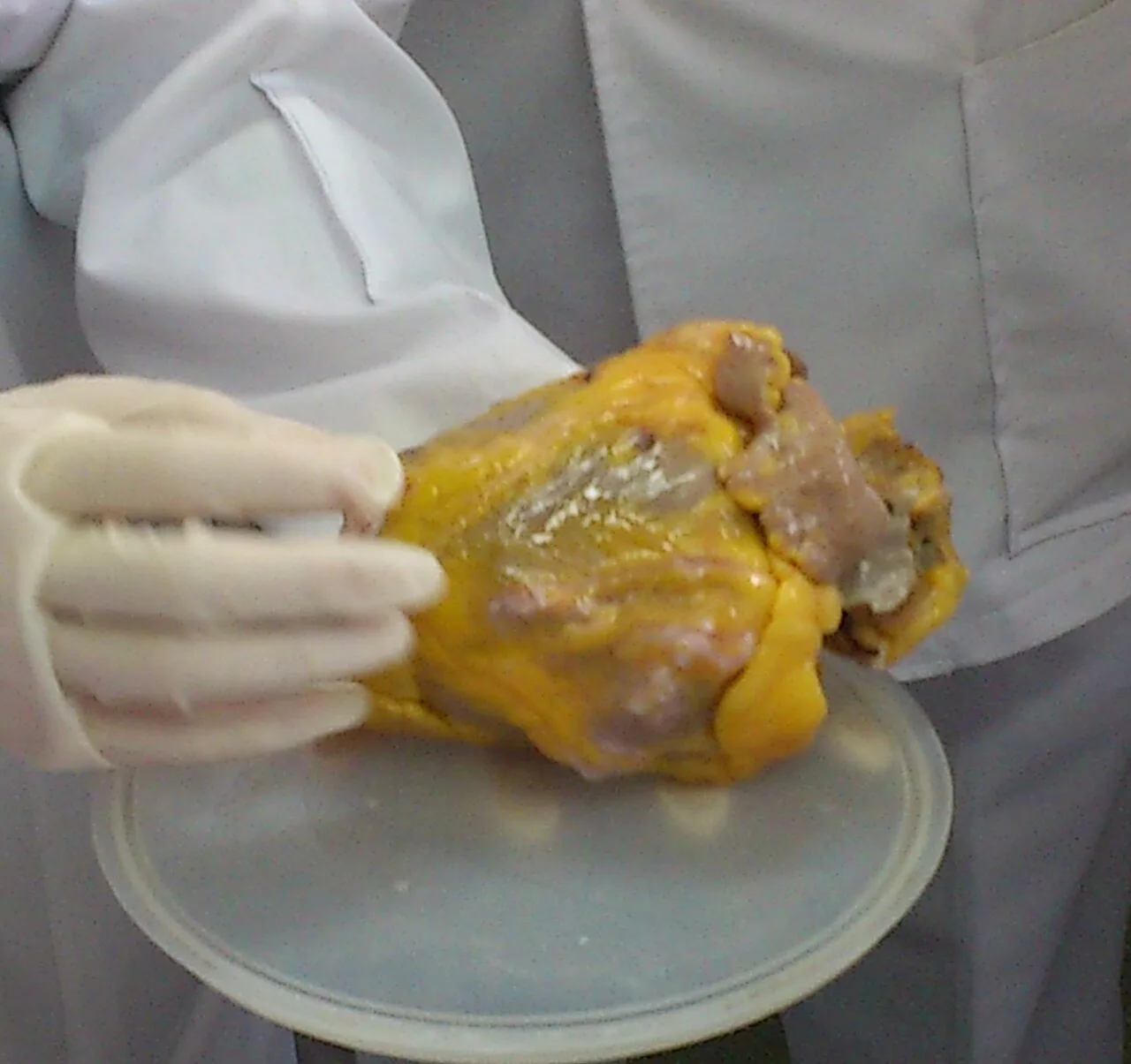 Calcified heart of an older woman with cardiomegaly